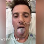 Krebs: Ein Vater verlor aufgrund von HPV fast seine Zunge