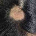 Was ist Alopecia Areata? – Film Daily